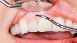 Effective Ways to Treat Gum Disease and Restore Healthy Gums