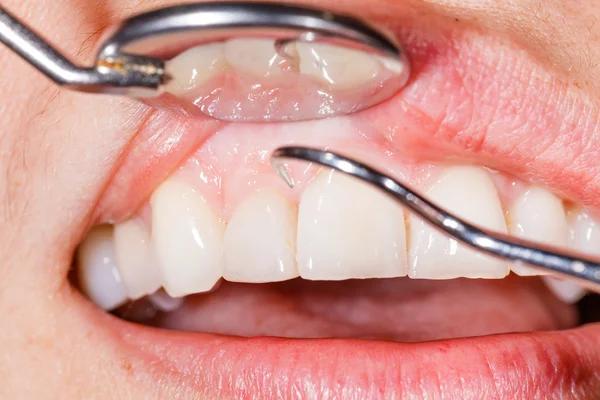Effective Ways to Treat Gum Disease and Restore Healthy Gums